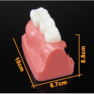 JX®M2017高品質歯科インプラント・クラウン歯模型