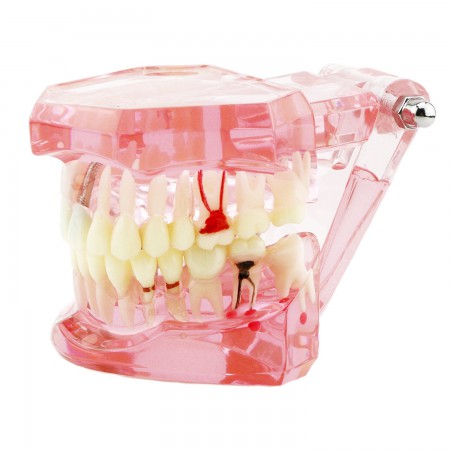 歯科上下顎180度開閉式インプラント歯の構造虫歯研究治療用模型