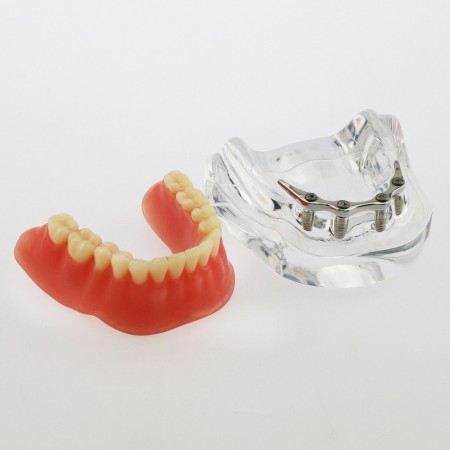 歯科下歯義歯模型4本インプラント オーバー デンチャー 下顎模型