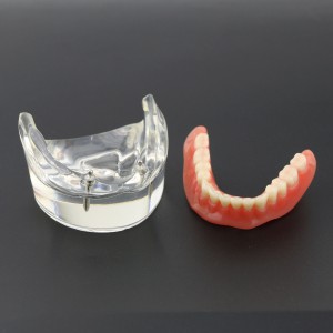 歯科模型下顎重塁義歯2本インプラント教学用模型6002 01