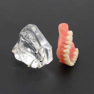 歯科教学用歯模型上顎重塁義歯4本インプラントデモ6001