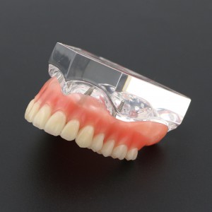 歯科教学用歯模型上顎重塁義歯4本インプラントデモ6001