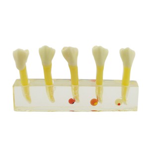 歯科5段階虫歯拡大模型歯科用虫歯治療説明展示用クリアベース