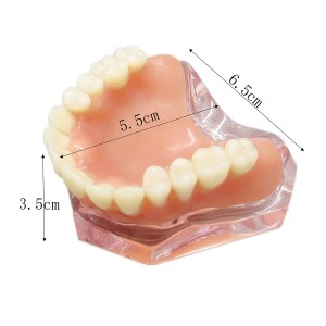 歯科上顎インプラント模型インプラント研究治療説明用4本釘 取り外し可能