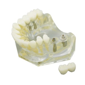 歯科インプラント治療説明用上顎模型4本インプラント脱着可能 クリアベース 透明