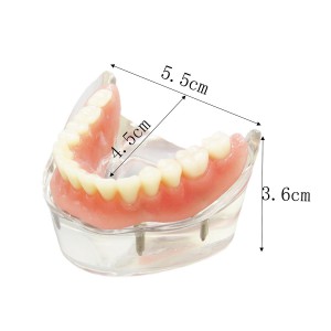 歯科下顎インプラント用模型 研究治療説明用4本インプラント脱着可能クリアベース 透明