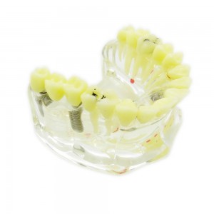 歯科透明インプラントモデル模型 歯科治療説明用虫歯付きの上顎模型 脱着可能