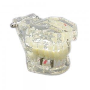 歯科上下顎180度開閉式インプラント模型虫歯治療説明用透明模型
