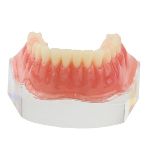 歯科下顎インプラントモデルバーアタッチメント研究治療説明用クリアベース 4本インプラント