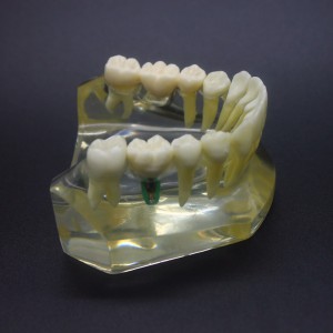 歯科1:1下顎歯科インプラント模型インプラント、ブリッジ付き2010