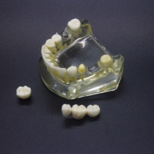 歯科1:1下顎歯科インプラント模型インプラント、ブリッジ付き2010