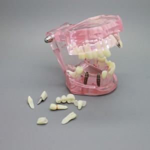 歯科インプラント解析デモ歯症モデルピンク