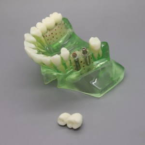 歯科模型＃2015 01 -上顎義歯インプラントモデル　副鼻腔付き