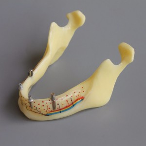 歯科模型＃2014 02 -下顎インプラントとオーバーデンチャーモデル（黄色）