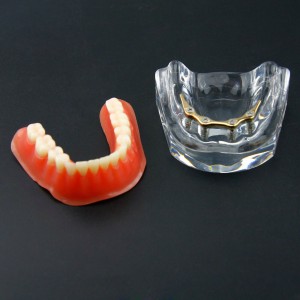歯科義歯模型オーバーデンチャー 精密インプラント ゴールデン下顎模型 6009