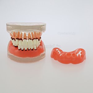 歯科上下顎歯周萎縮模型 開閉式歯結石模型 歯科研究治療説明用歯列疾患モデル クリアベース