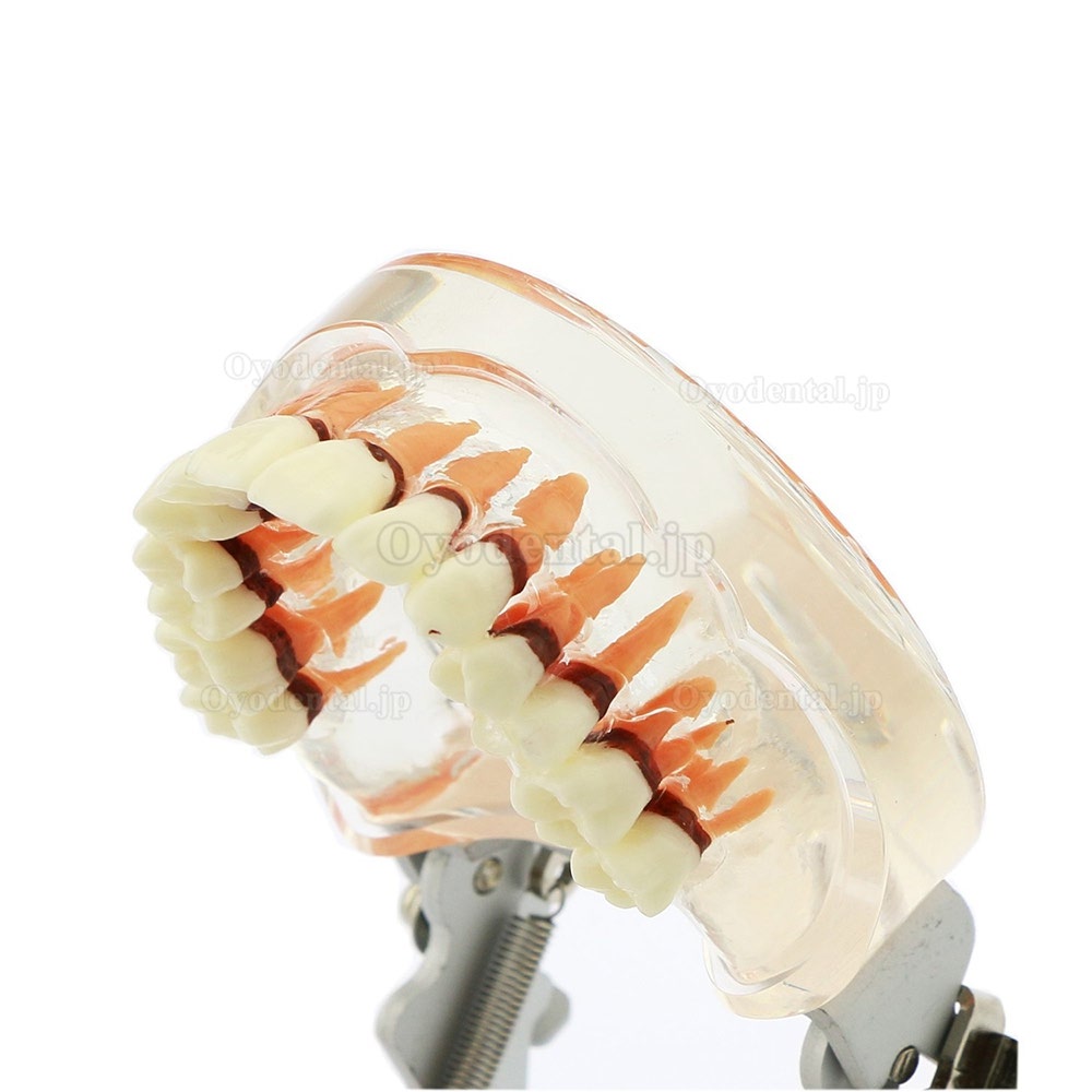 歯科上下顎歯周萎縮模型 開閉式歯結石模型 歯科研究治療説明用歯列疾患モデル クリアベース
