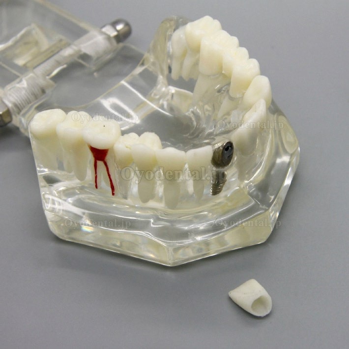 歯科インプラント研究分析用モデル歯科疾患と回復モデル