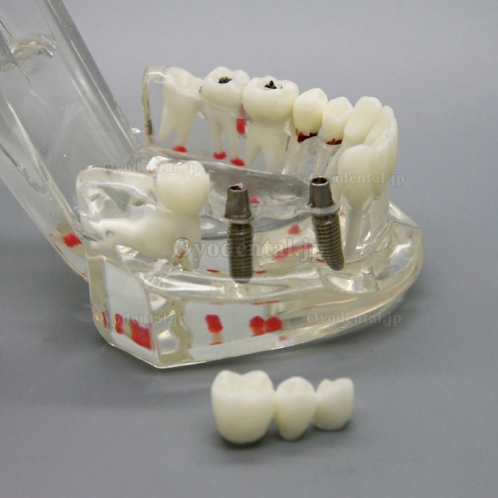 歯科インプラント研究分析用モデル歯科疾患と回復モデル