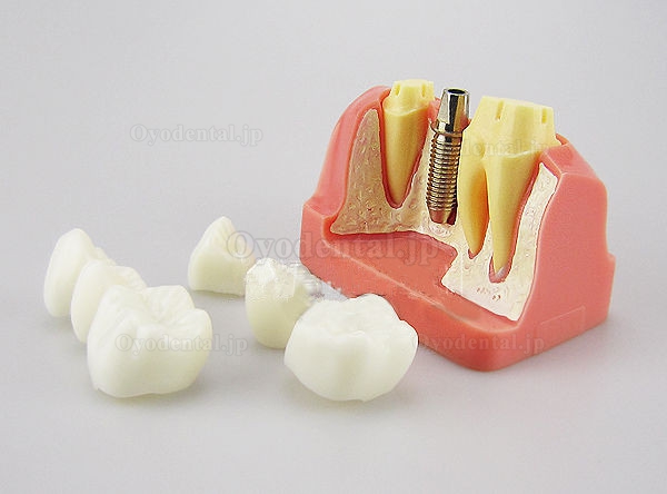 JX®M2017高品質歯科インプラント・クラウン歯模型