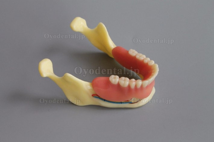 歯科模型＃2014 02 -下顎インプラントとオーバーデンチャーモデル（黄色）
