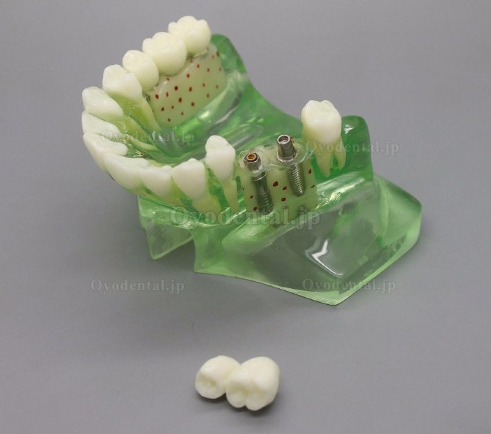 歯科模型＃2015 01 -上顎義歯インプラントモデル 副鼻腔付き