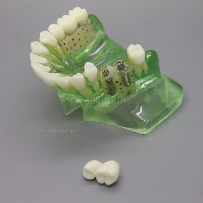 歯科模型＃2015 01 -上顎義歯インプラントモデル 副鼻腔付き