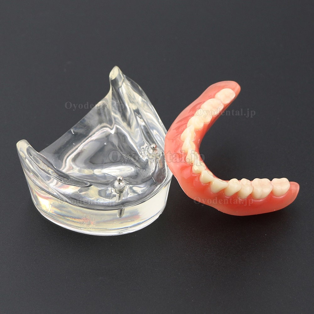 歯科模型下顎重塁義歯2本インプラント教学用模型6002 01