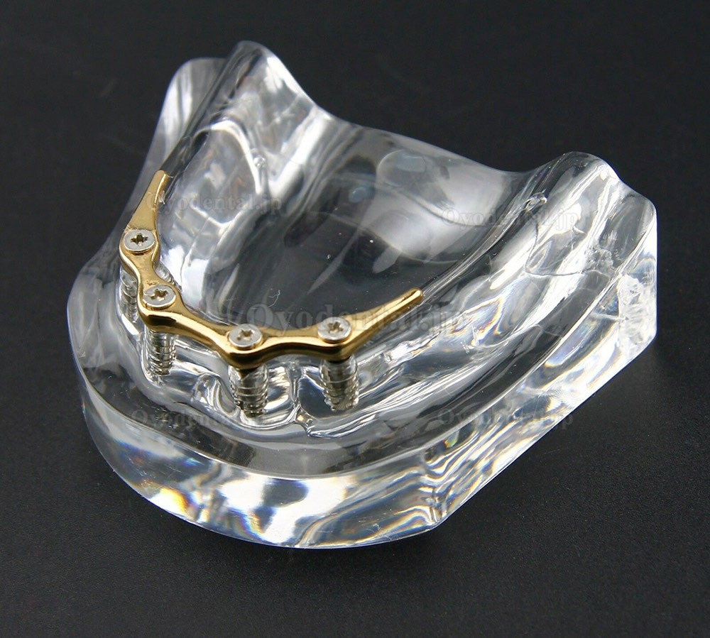 歯科義歯模型オーバーデンチャー 精密インプラント ゴールデン下顎模型 6009