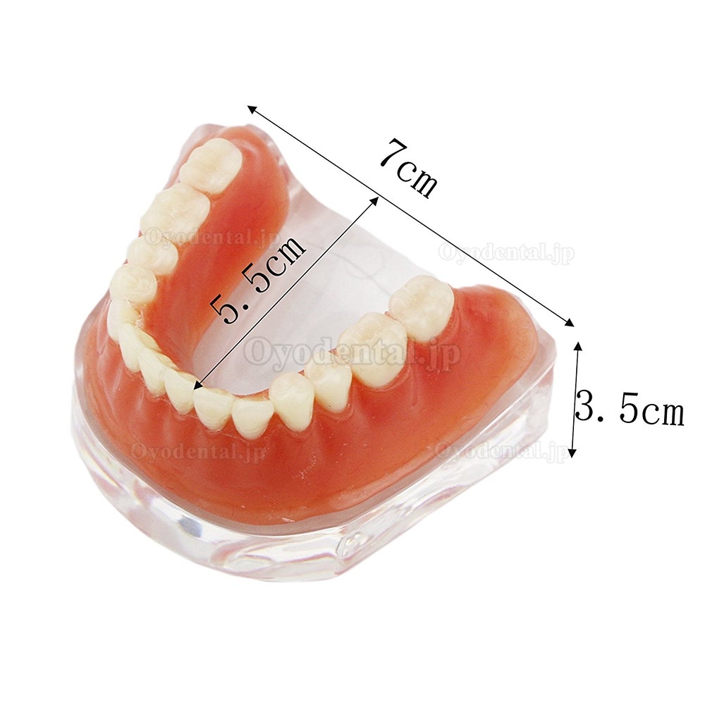 歯科下顎インプラントモデルバーアタッチメント研究治療説明用クリアベース 4本インプラント