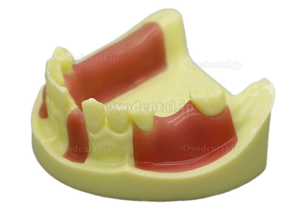 歯科模型下顎インプラント練習モデル 歯肉付き #2004 01
