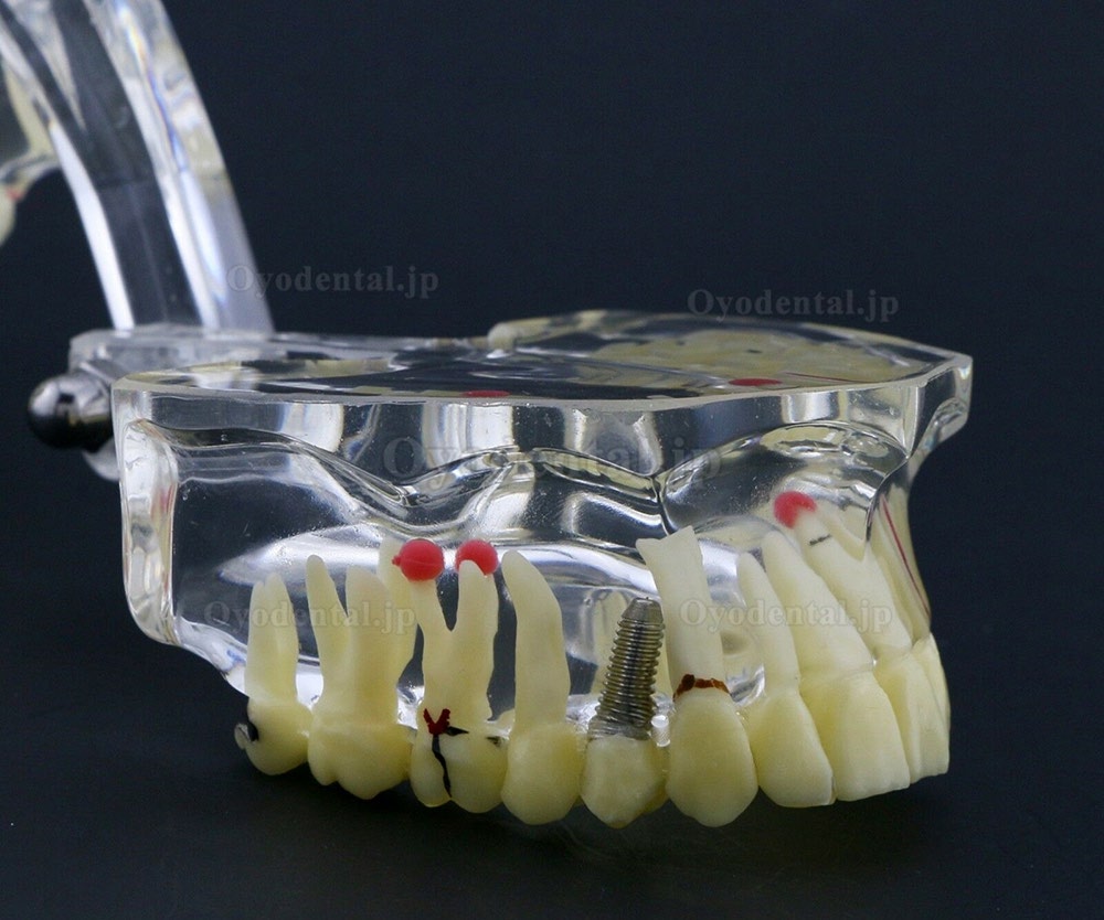 新しい歯科模型 成人病理歯模型モデル模型教学研究説明用#4001