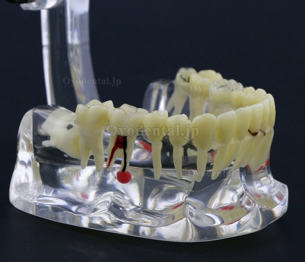 新しい歯科模型 成人病理歯模型モデル模型教学研究説明用#4001