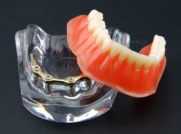 歯科用オーバーデンチャー歯モデル下顎精密インプラント金色