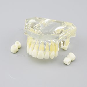 歯科インプラント治療説明用上顎模型4本インプラント脱着可能 クリアベース 透明