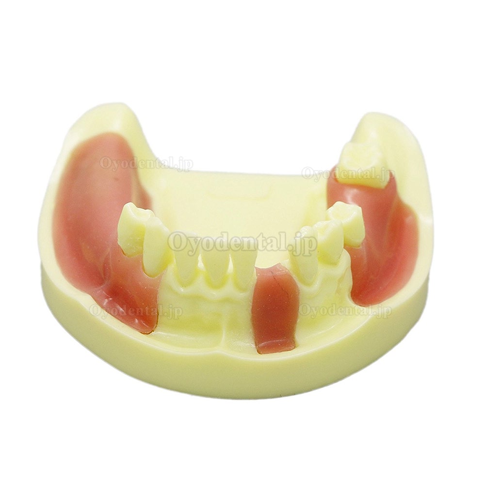 歯科下顎義歯模型 インプラント研究練習用道具 イエローベース