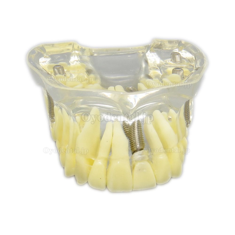 歯科上顎模型インプラントモデル模型 歯列研究用治療説明用教学模型 脱着可能 4本インプラント クリアベース 透明