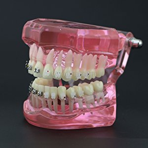 歯科上下顎治療説明用矯正模型 ブラケットモデル セラミック メタル ピンク