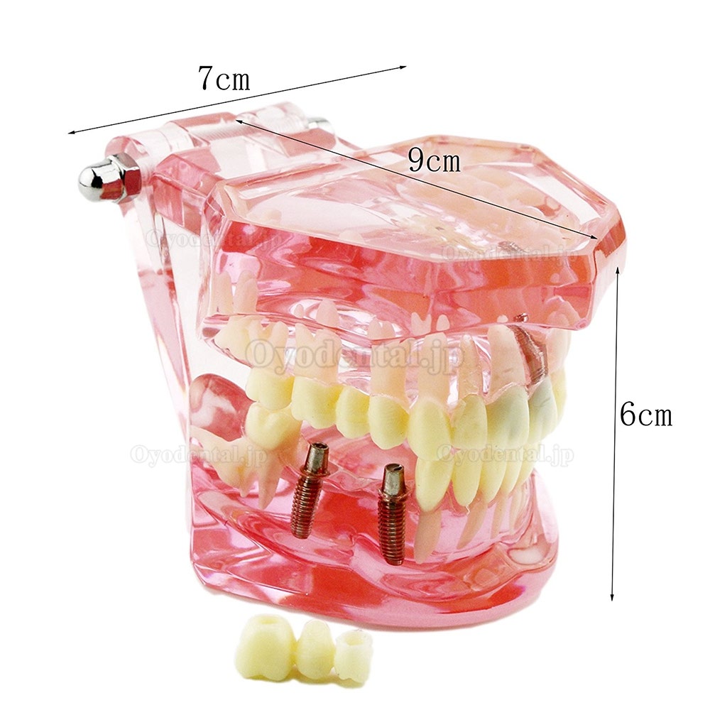 歯科上下顎180度開閉式インプラント歯の構造虫歯研究治療用模型