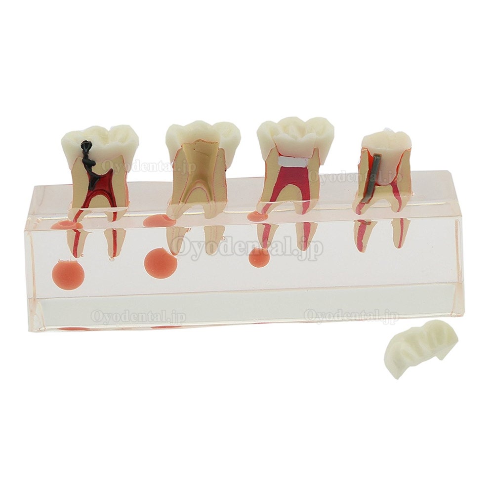 虫歯拡大モデル透明虫歯歯髄炎治療説明用模型
