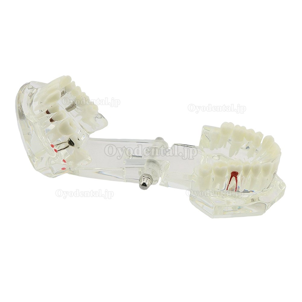 歯科上下顎180度開閉式インプラント模型虫歯治療説明用透明模型