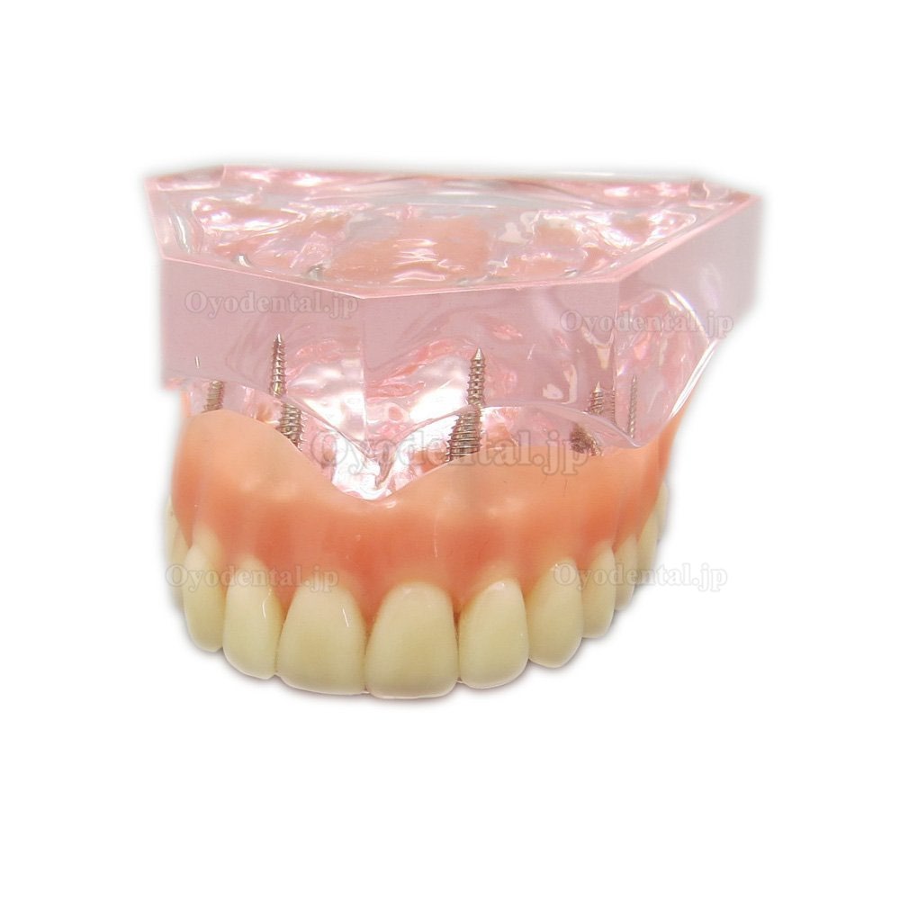 歯科上顎インプラント模型インプラント研究治療説明用4本釘 取り外し可能
