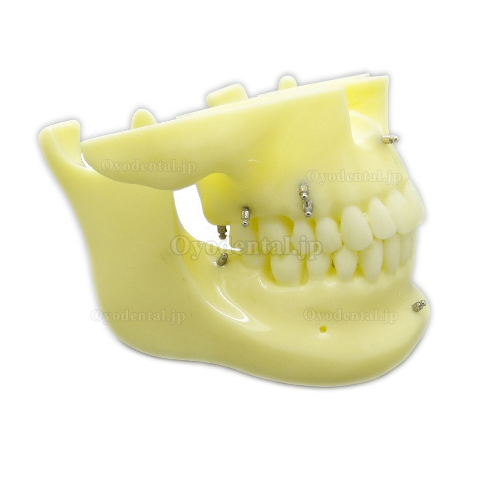 歯科矯正用上下顎歯列模型模型 インプラントモデル スクリューアンカー付き 脱着可能 イエローベース