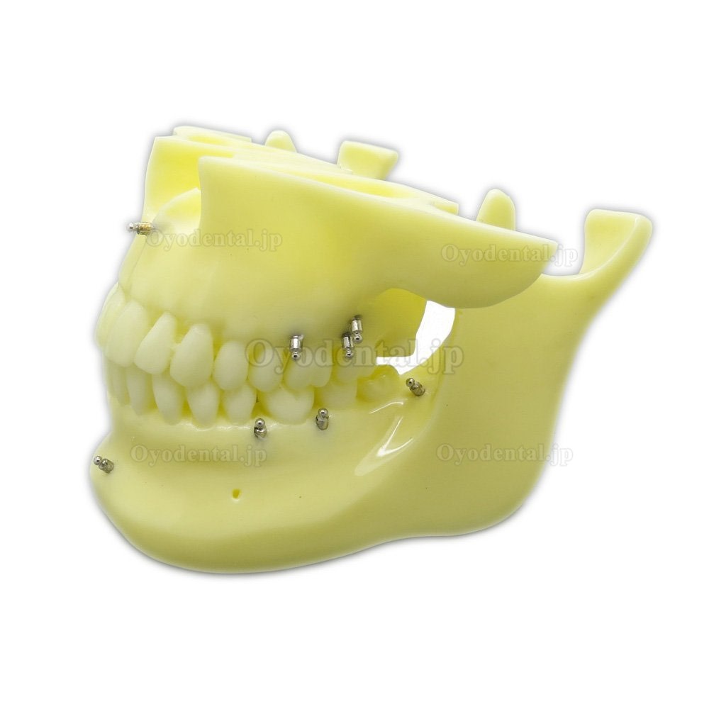 歯科矯正用上下顎歯列模型模型 インプラントモデル スクリューアンカー付き 脱着可能 イエローベース